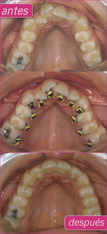 Ortodoncia Lingual o Invisible