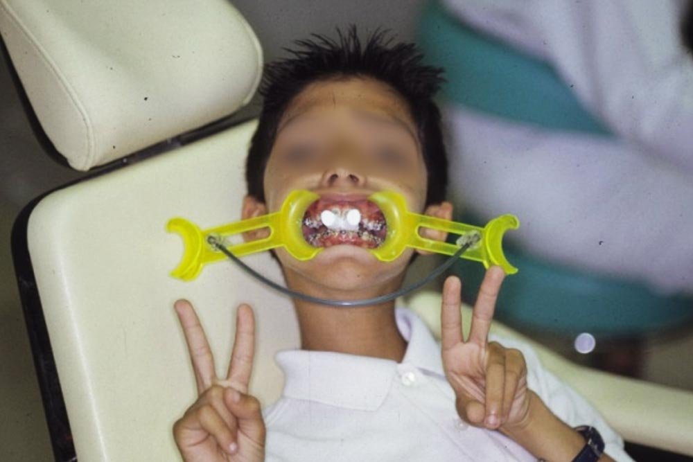Ortodoncia convencional (niños y adultos)